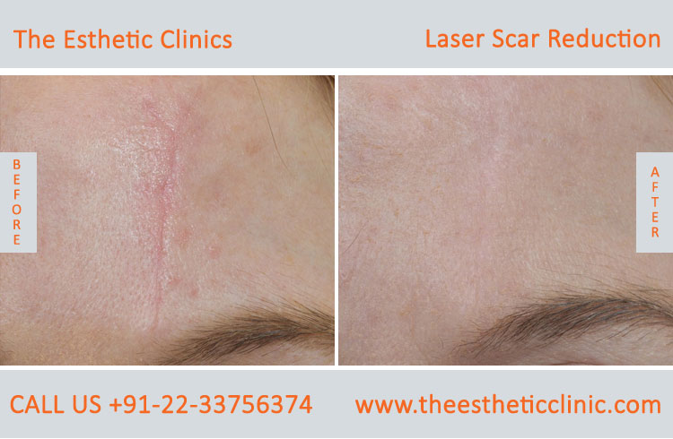 Laser scar reduction removal Treatment before after photos in mumbai india (1)